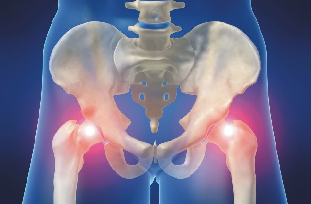 OTSZ Online - A csípőfájdalom kivizsgálása, Csípő artrózisa 1 és 2 fokú kezelés